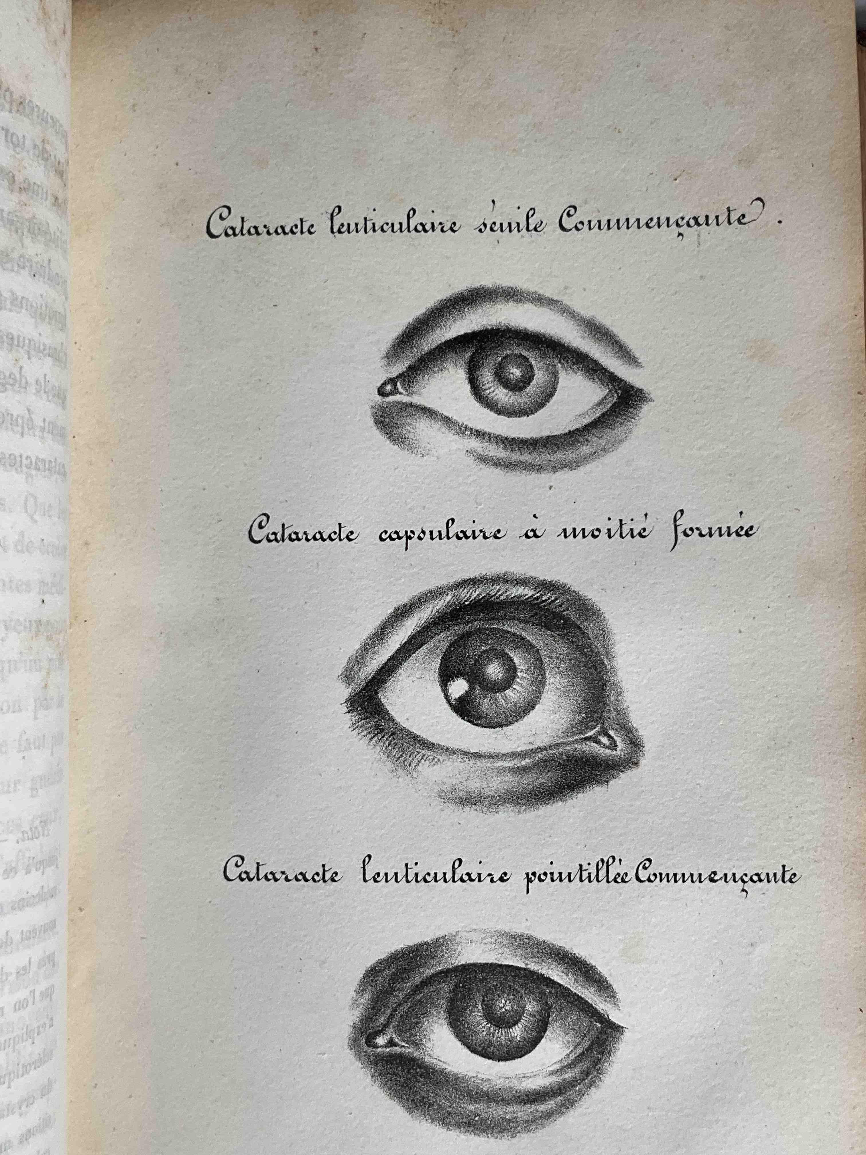 [Ophtalmologie] 3 ouvrages autour de la cataracte en 1 volume...